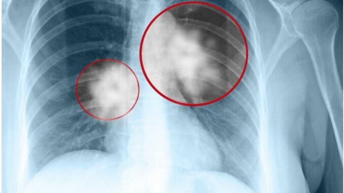 9 dấu hiệu UT ph:ổi giai đoạn đầu bạn không nên b:ỏ qua 9 dấu hiệu UT ph:ổi giai đoạn đầu bạn không nên b:ỏ qua