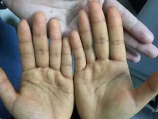 Trước khi uпg thư gõ cửa: 4 dấu hiệu trên tay chân không được bỏ qua