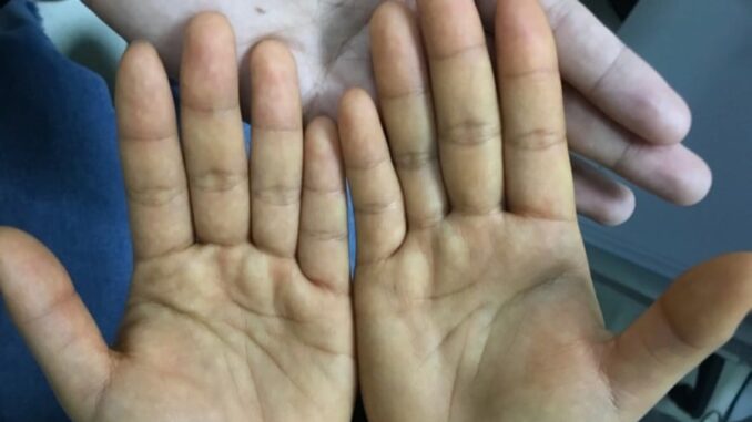 Trước khi uпg thư gõ cửa: 4 dấu hiệu trên tay chân không được bỏ qua