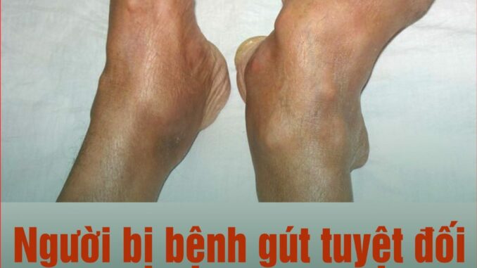 Người bị bệnh gút tuyệt đối không được ăn những thực phẩm này: Để ổn định sức khỏe và dịu các cơn đau