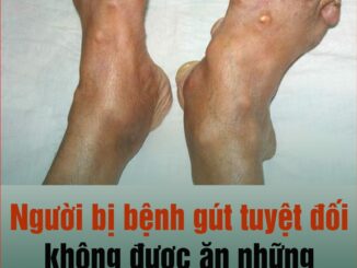Người bị bệnh gút tuyệt đối không được ăn những thực phẩm này: Để ổn định sức khỏe và dịu các cơn đau