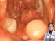 Cảnh báo dấu hiệu khi đi ngoài chứng tỏ cơ thể đã bị ung thư đại tràng, cần đi khám gấp