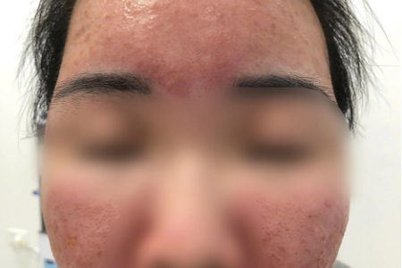 Nữ sinh cháy da vì tin lời quảng cáo kem "siêu chống nắng" giá rẻ trên mạng Nữ sinh cháy da vì tin lời quảng cáo kem "siêu chống nắng" giá rẻ trên mạng