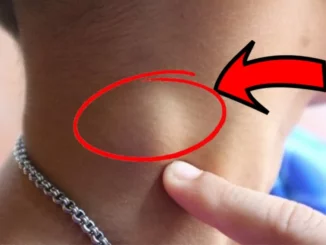 Người sắp bị K tấn công thường có 3 dấu hiệu lạ ở cổ, số 1 nguy hiểm nhất