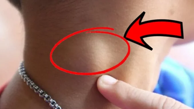 Người sắp bị K tấn công thường có 3 dấu hiệu lạ ở cổ, số 1 nguy hiểm nhất Người sắp bị K tấn công thường có 3 dấu hiệu lạ ở cổ, số 1 nguy hiểm nhất