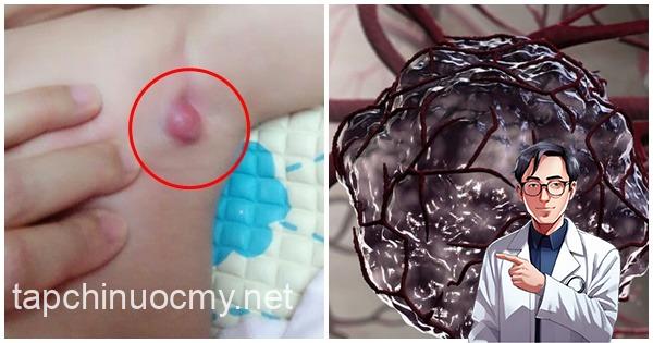 9 triệu chứng ‘điển hình’ báo hiệu trẻ nhỏ bị ung thư giai đoạn đầu: Mẹ đưa con đến viện ngay 9 triệu chứng ‘điển hình’ báo hiệu trẻ nhỏ bị ung thư giai đoạn đầu: Mẹ đưa con đến viện ngay