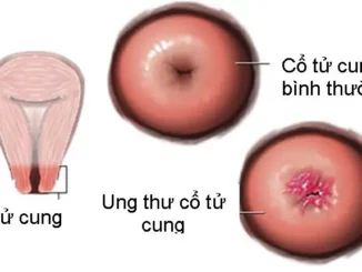 8 dấu hiệu cảnh báo ung thư cổ tử cung