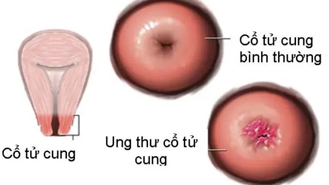 8 dấu hiệu cảnh báo ung thư cổ tử cung 8 dấu hiệu cảnh báo ung thư cổ tử cung