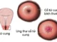8 dấu hiệu cảnh báo ung thư cổ tử cung