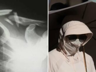 Một phụ nữ bị gãy xương do thói quen che nắng cẩn thận quá mức