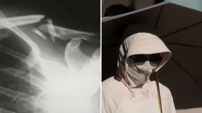 Một phụ nữ bị gãy xương do thói quen che nắng cẩn thận quá mức