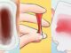 5 dấu hiệu u-ng thư cổ t-ử cung sớm nhất: 90% chị em xem thường bỏ qua